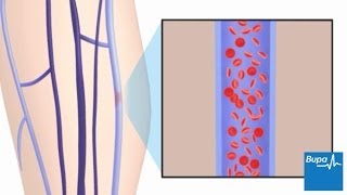 How superficial thrombophlebitis develops [upl. by Assilen679]