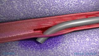 Peripheral IV Infiltration Animation [upl. by Chobot292]