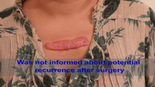 Chest Keloids  Mistakes to Avoid [upl. by Hollah376]