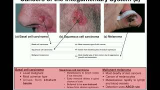 Anatomy  The Three Types of Skin Cancers [upl. by Kal753]